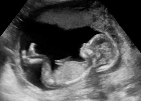 echo zwangerschap echo zwangerschap